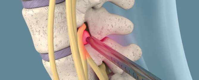 Endoscopia de Coluna: Menos Dor, Mais Recuperação
