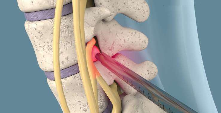 Endoscopia de Coluna: Menos Dor, Mais Recuperação