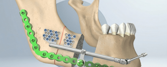 Excelência Alemã em Cirurgia Maxilofacial: Distratores